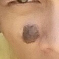 Help me brayy.. Tanda lahir / Nevus / Tompel ane kebesaran.. hiks