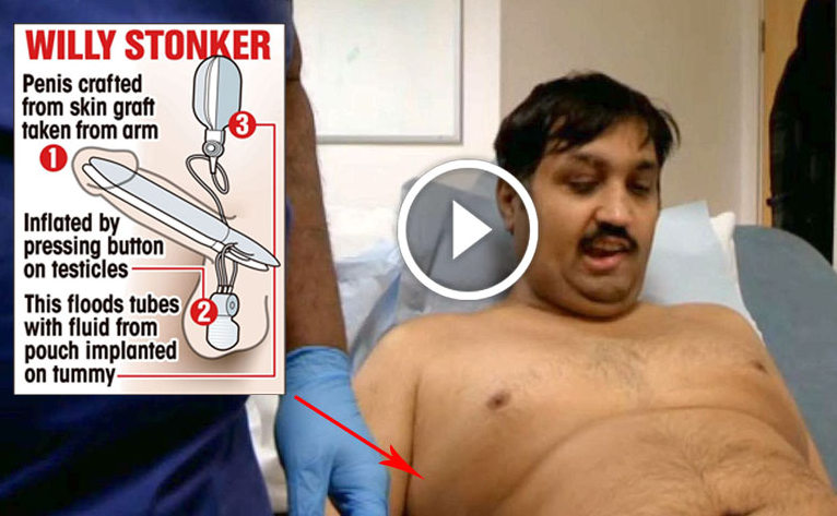 Pria ini Gunakan Penis Bionik