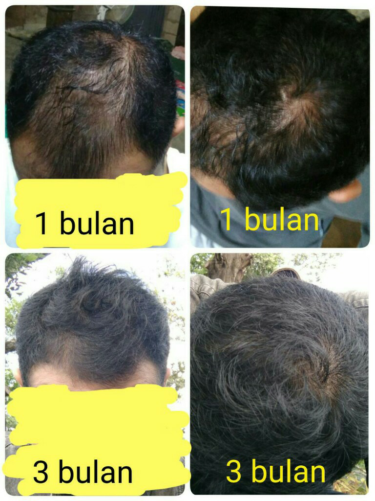 Balasan dari help rambut gua rontok hampir botak 2 Part 