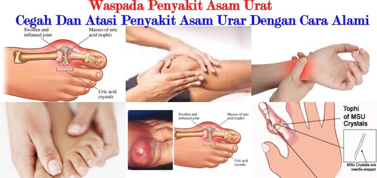 Anda kena asam urat