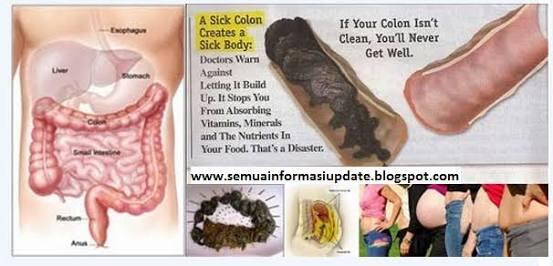 BASMI RACUN DALAM USUS, ALAMI!!!