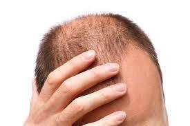 &#91;SHARE&#93; Trichotillomania, kebiasaan buruk dari kecil hingga sekarang