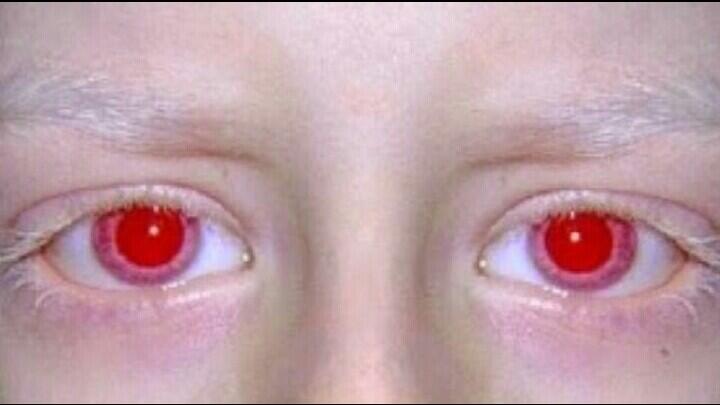 Penyakit-Penyakit Mata Yg Mengerikan