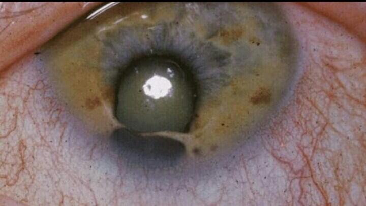 Penyakit-Penyakit Mata Yg Mengerikan