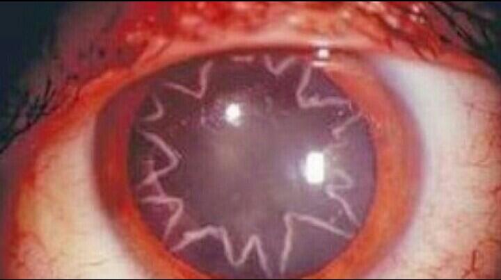 Penyakit-Penyakit Mata Yg Mengerikan