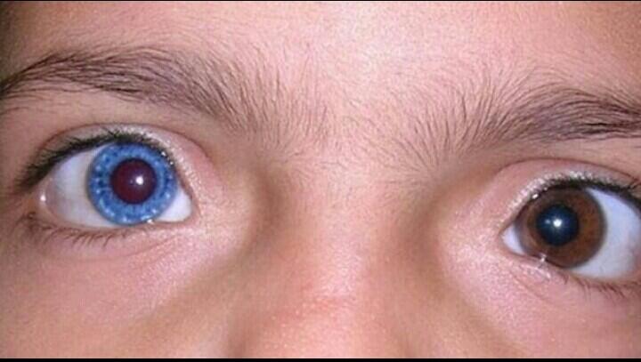 Penyakit-Penyakit Mata Yg Mengerikan