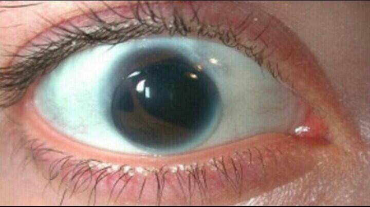 Penyakit-Penyakit Mata Yg Mengerikan