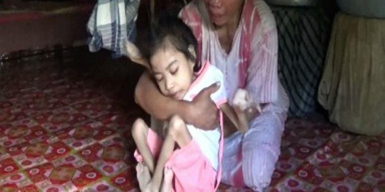 Berat Badan Bocah Berusia 13 Tahun Asal Pinrang Ini Hanya 5 Kilogram