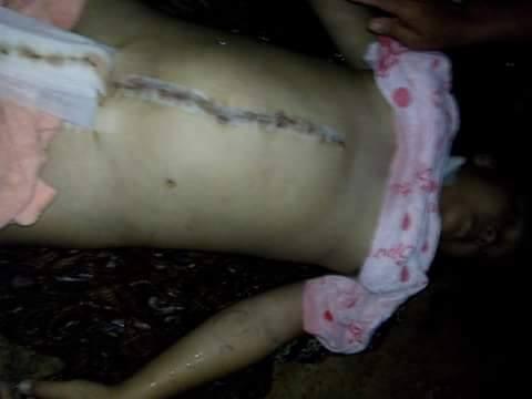 (Lokal) Korban Operasi Usus Buntu