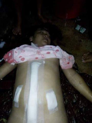 (Lokal) Korban Operasi Usus Buntu