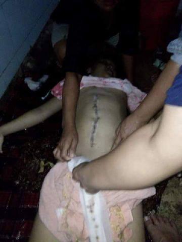 (Lokal) Korban Operasi Usus Buntu