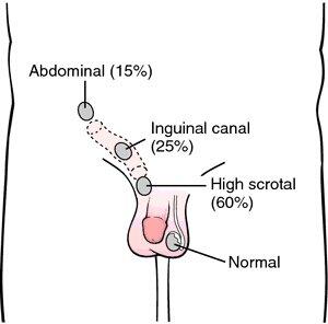 INILAH KISAH HIDUP ANE,SANG PENGIDAP UNDESENSUS TESTIS