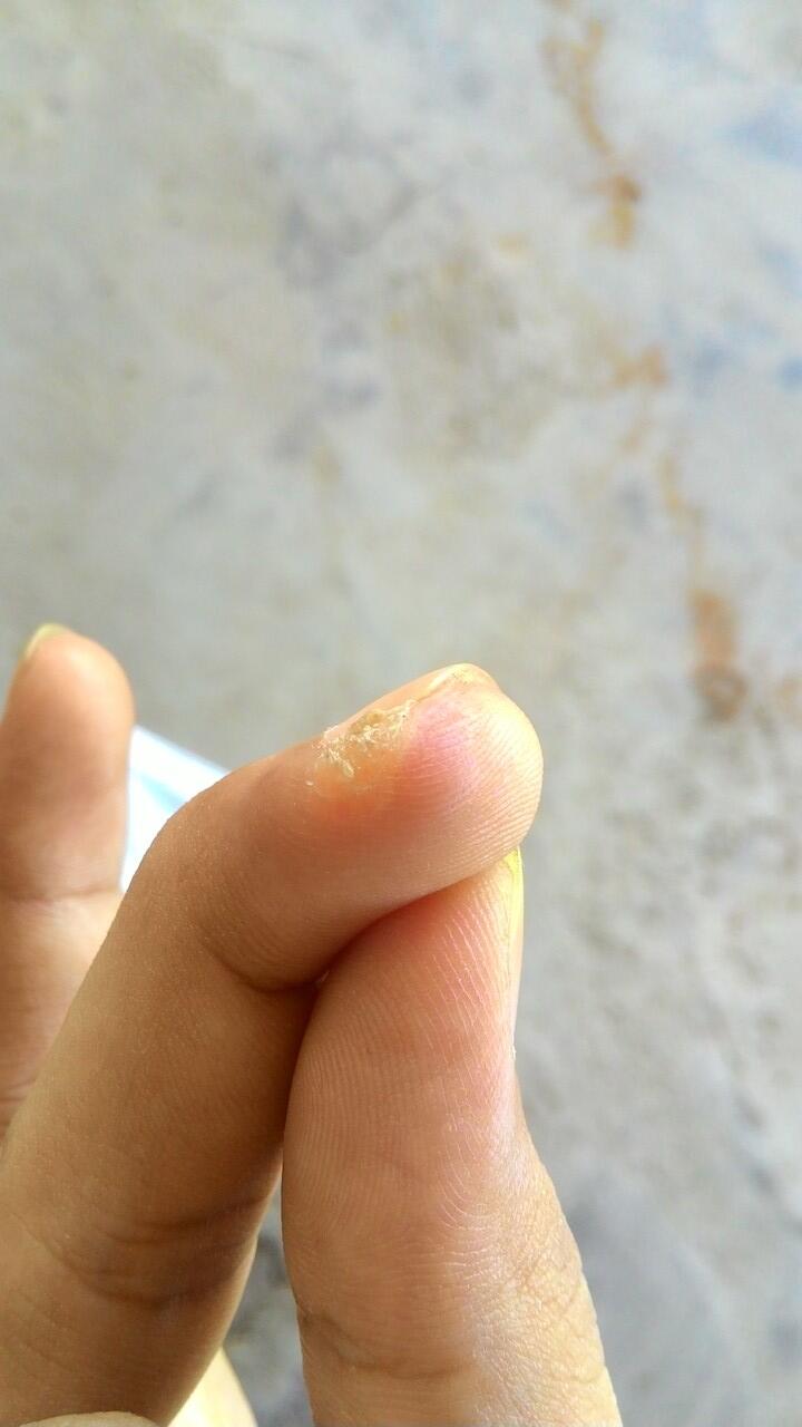 HELP bantu infonya soal penyakin saya ini (kulit)