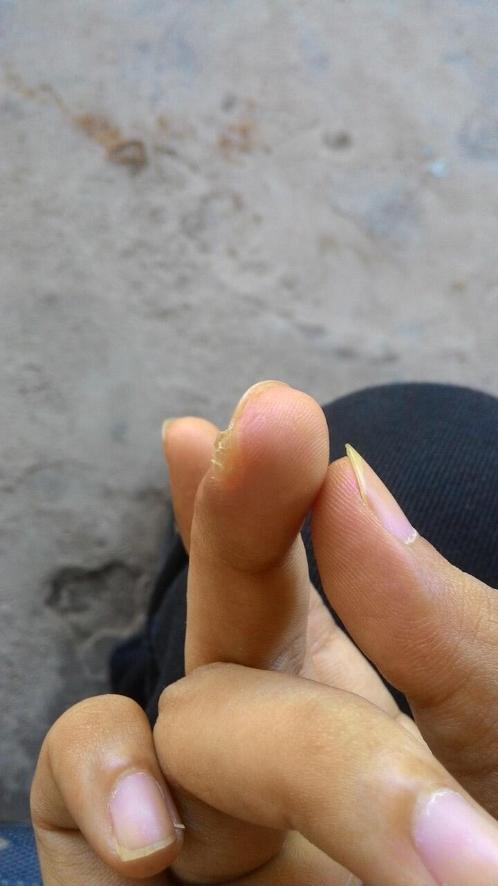 HELP bantu infonya soal penyakin saya ini (kulit)