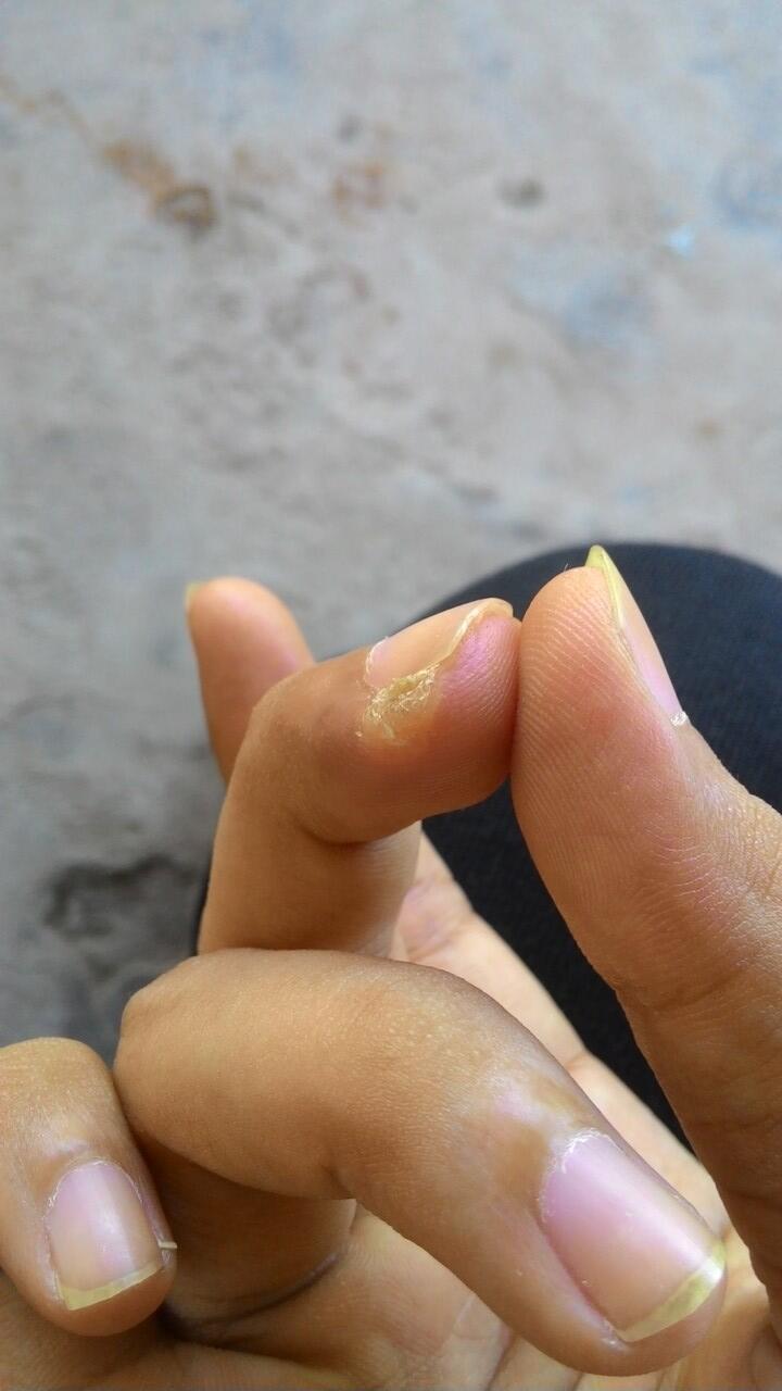 HELP bantu infonya soal penyakin saya ini (kulit)