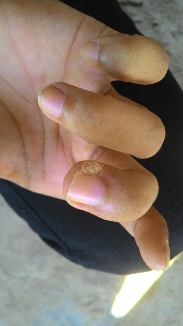 HELP bantu infonya soal penyakin saya ini (kulit)