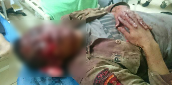 Donasi untuk Rekonstruksi Wajah Polisi Korban Suporter Brutal