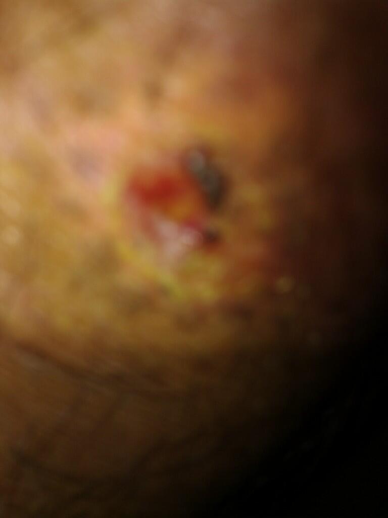 HELP luka koreng / keropeng