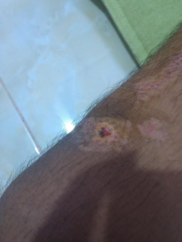 HELP luka koreng / keropeng