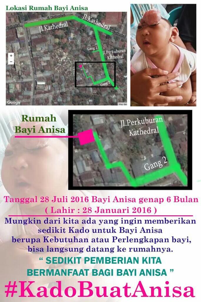 Bayi Anisa terlahir dengan Kelainan Congenital Anencephaly. Yuk kenal lebih dekat.