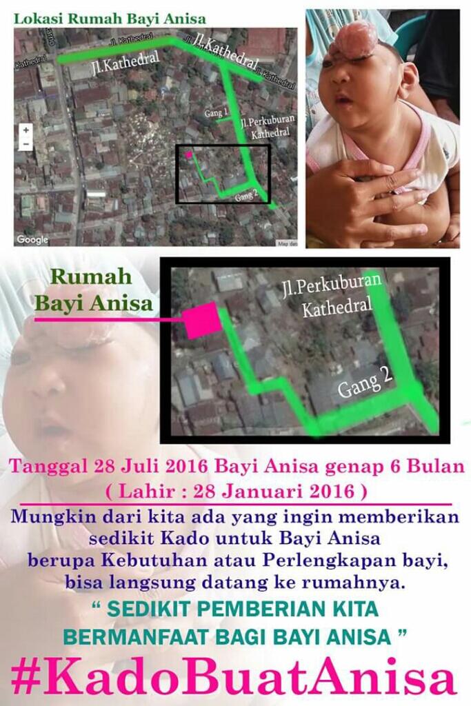 Bayi Anisa yang terlahir dengan kondisi tanpa Tempurung Kepala
