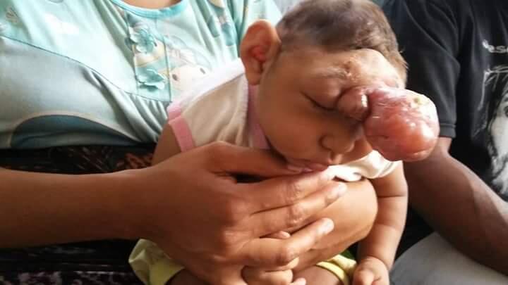 Bayi Anisa yang terlahir dengan kondisi tanpa Tempurung Kepala