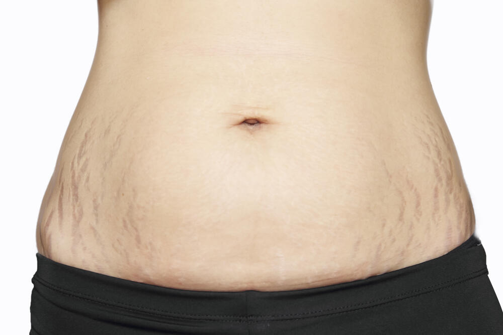 Kulit Bebas Stretchmark Setelah Hamil? Bisa Dong !