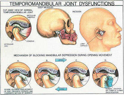 Temporomandibular ( Nikmatnya Menguap Tak Seindah Yang Di Bayangkan! )