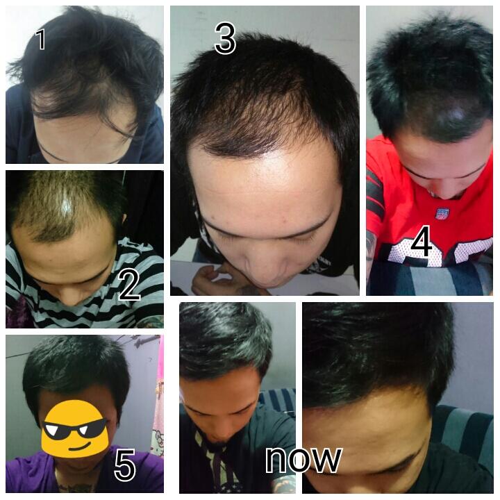 Mereka yang  sudah  berhasil menumbuhkan rambut  KASKUS