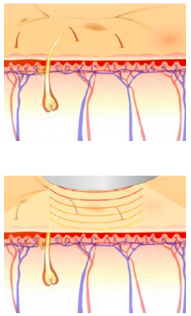 I2PL Lebih Baik Dari Laser? Cek Disini Yuk Sis!