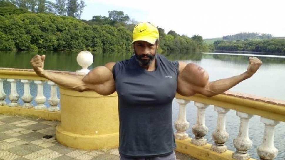 Niat Jadi Hulk, Lelaki Ini Suntikkan Cairan Berbahaya ke Tubuhnya !Ngerriii