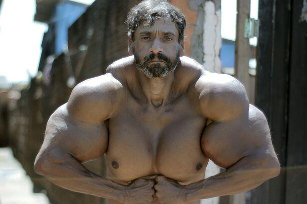 Suntik minyak ke tubuh, Pria ini jadi hulk