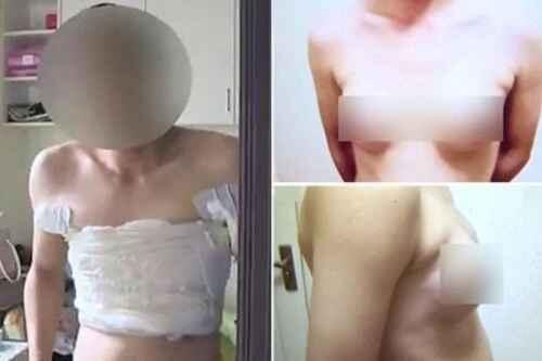 Pria China Implan Payudara agar Cepat Dapat Kerja