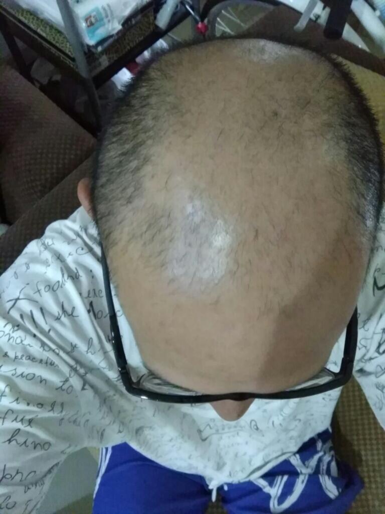 Rambut Gua Rontok Hampir Botak Page 16 KASKUS