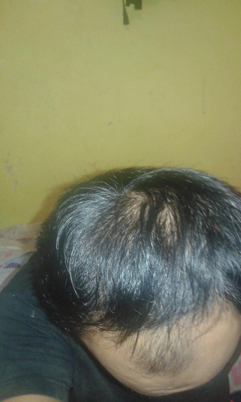 Rambut Gua Rontok Hampir Botak Page 16 KASKUS