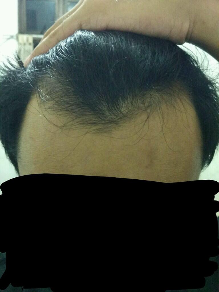 Rambut Gua Rontok Hampir Botak Page 21 KASKUS