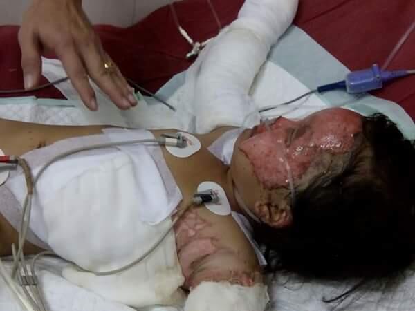 Bocah Trinity Korban Bom Molotov di Samarinda dalam Kondisi Kritis