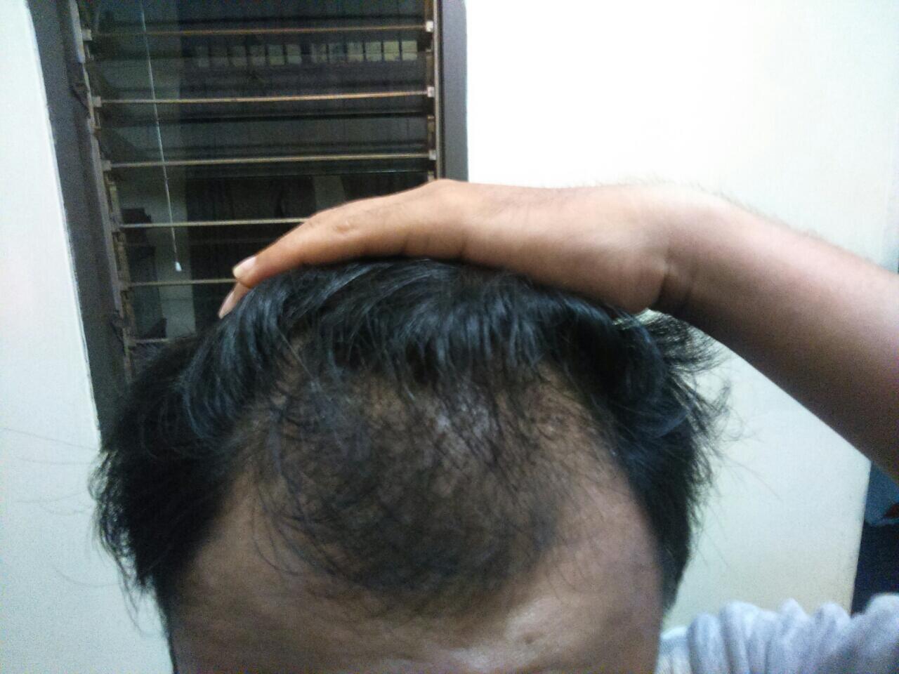 Rambut Gua Rontok Hampir Botak Page 35 KASKUS