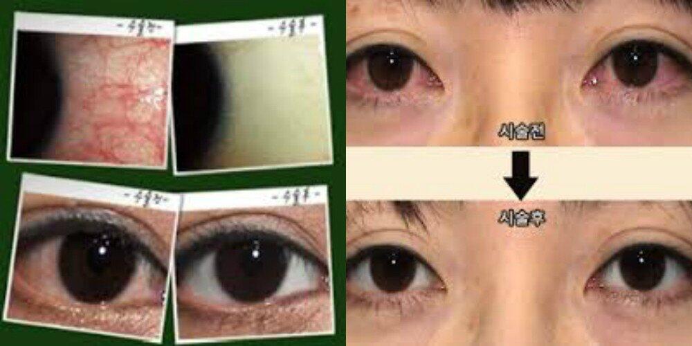 Operasi-operasi Umum yang Sering Dilakukan di Korea