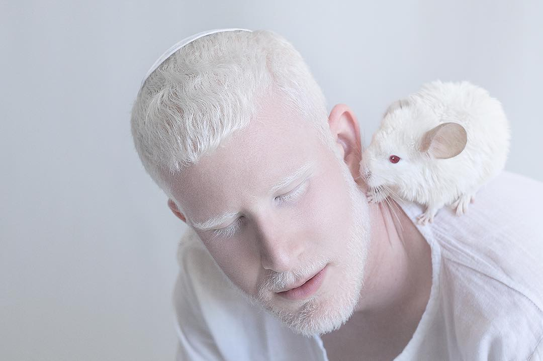 Beberapa Fakta Tentang Albino dan Potret Cantik dari Penderita Albino