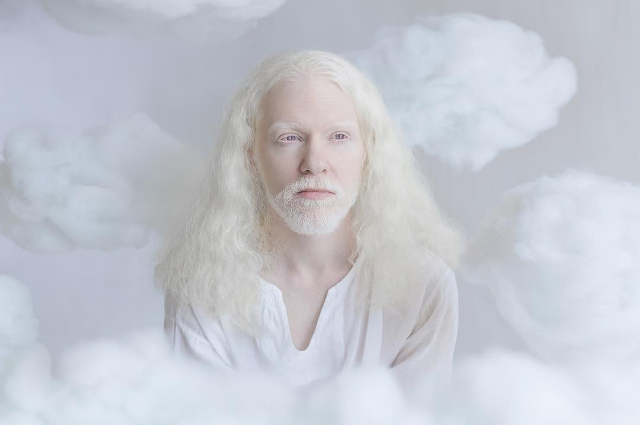Beberapa Fakta Tentang Albino dan Potret Cantik dari Penderita Albino