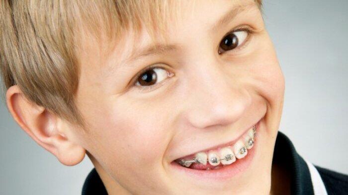 Boleh Tidak Anak Pasang Kawat Gigi? Ini Penjelasan Ahli