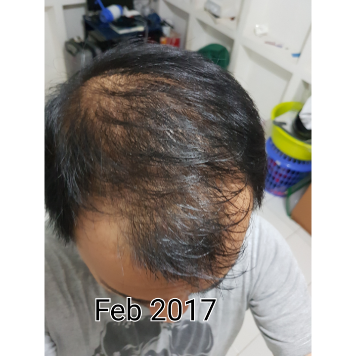 Rambut Gua Rontok, hampir Botak - Page 60  KASKUS