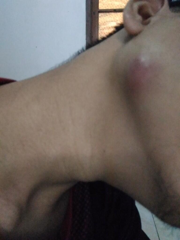 Gimana cara mengatasi jerawat batu yg tidak ada mata?