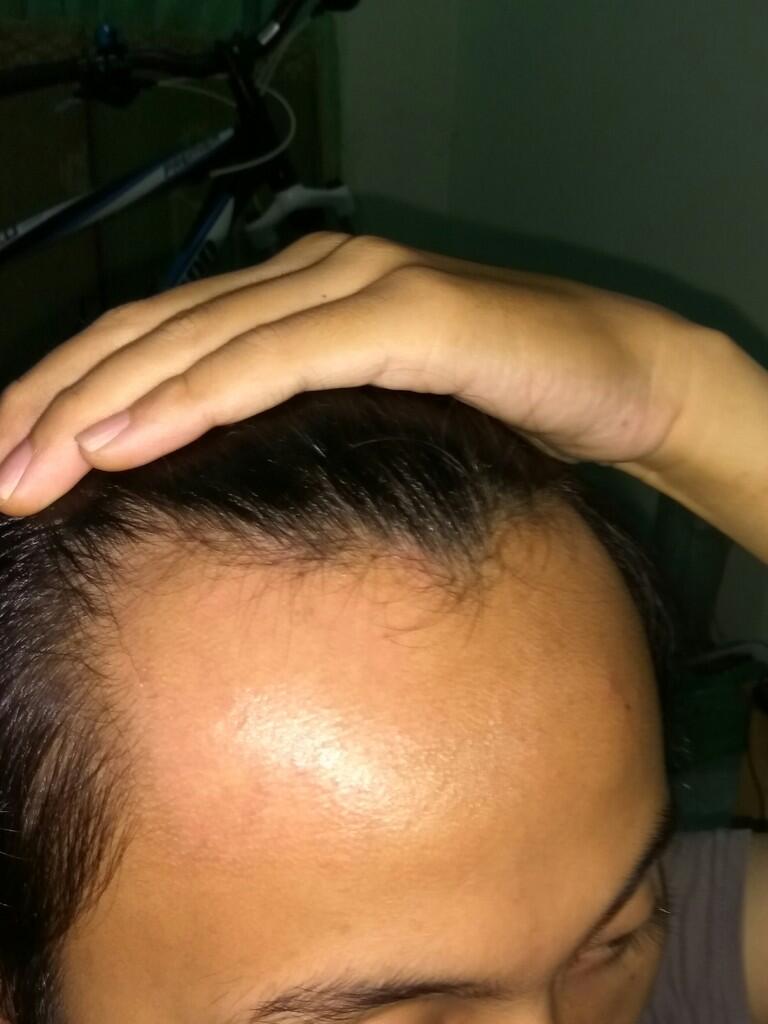 Rambut Gua Rontok Hampir Botak Page 69 KASKUS