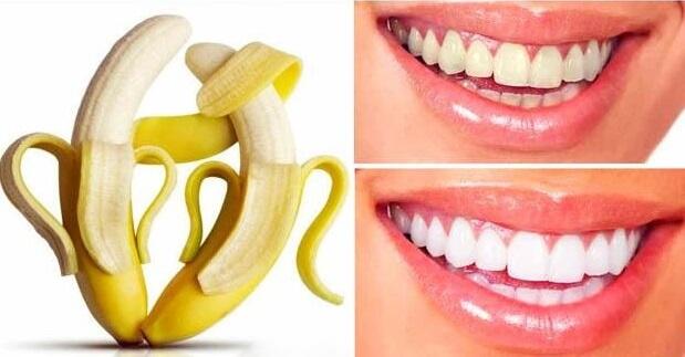 Memutihkan Gigi dengan Kulit Pisang