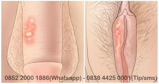Obat herbal penyakit menular seksual |Gonore |Sipilis |ISK |Kutil kelamin