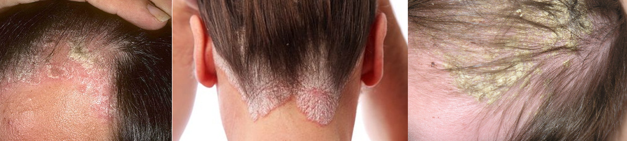 Obat herbal penyakit kulit/gatal eksim basah kering/kurap/kudis/bisul/gudikan/borok