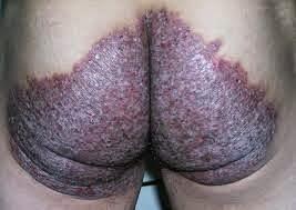 Obat herbal penyakit kulit/gatal eksim basah kering/kurap/kudis/bisul/gudikan/borok