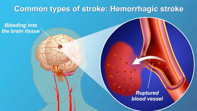 Bisa Bermata Dua, Membunuhmu Dalam 15 menit, Tapi Bisa Menyelamatkanmu dari Stroke